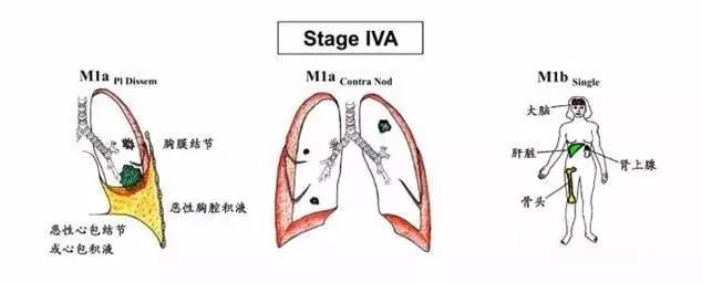 tanner分期标准图_乳腺癌tnm分期标准图_tnm分期标准图 tanner分期标准图_乳腺癌tnm分期标准图_tnm分期标准图
